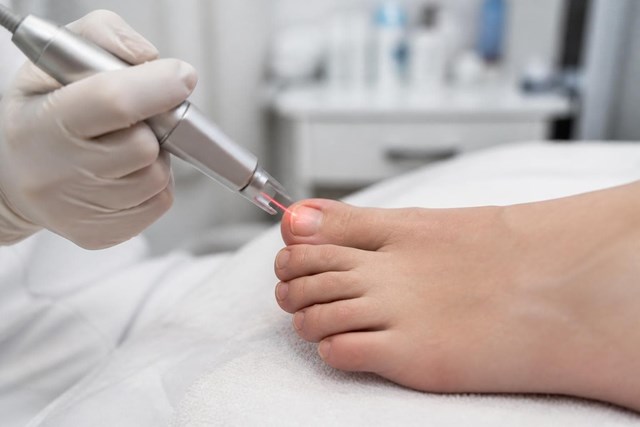 Elimina los hongos de las uñas con láser podológico en Tui - Imagen 2